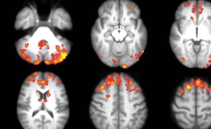 Sclérose latérale amyotrophique (SLA) et démence : le microbiome intestinal pointé du doigt par la science