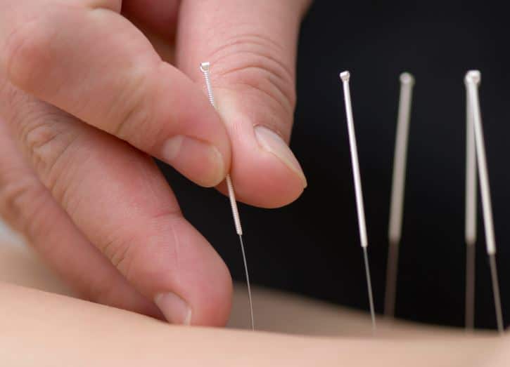 Étude : L’acupuncture améliore le sommeil des personnes atteintes de la maladie de Parkinson