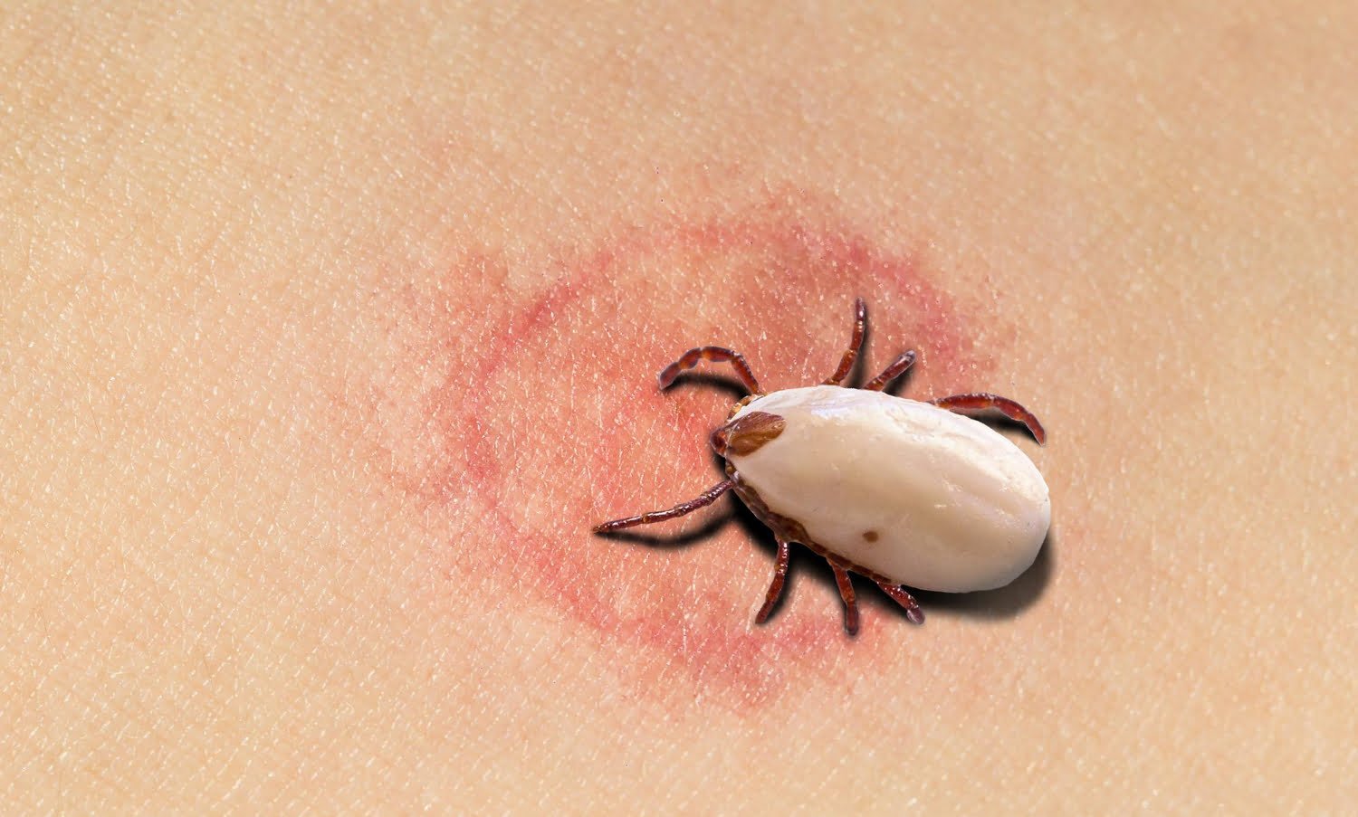 Maladie de Lyme : les bénéfices des approches naturelles