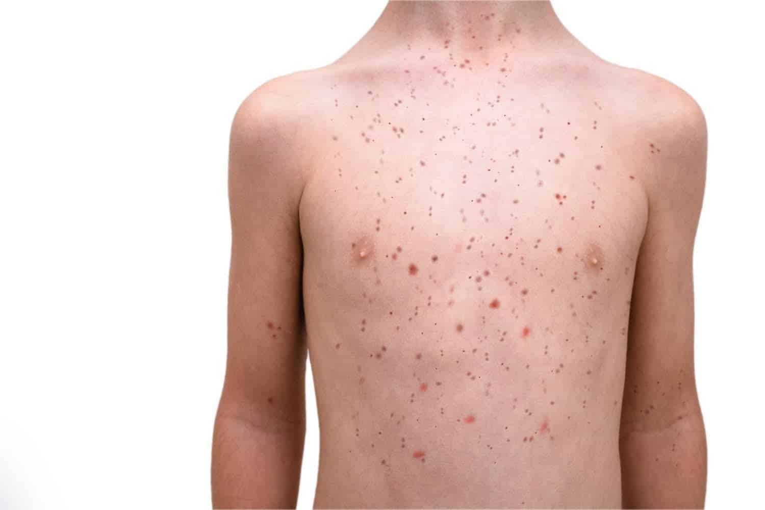 Rougeole: prévention et huiles essentielles qui aident à lutter