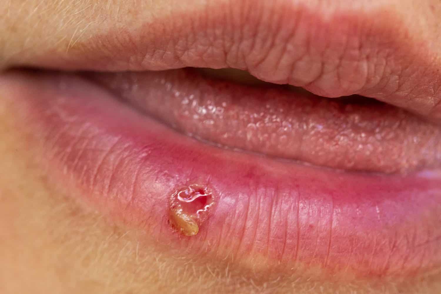 7 astuces pour éviter les boutons de fièvre en hiver