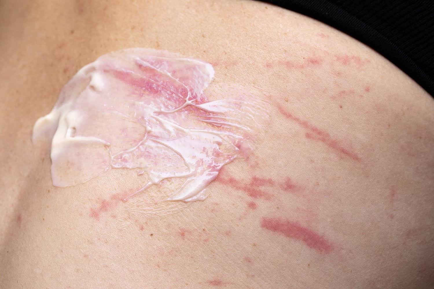 Quelle place pour la souche homéopathique Cortisone dans les traitements ?