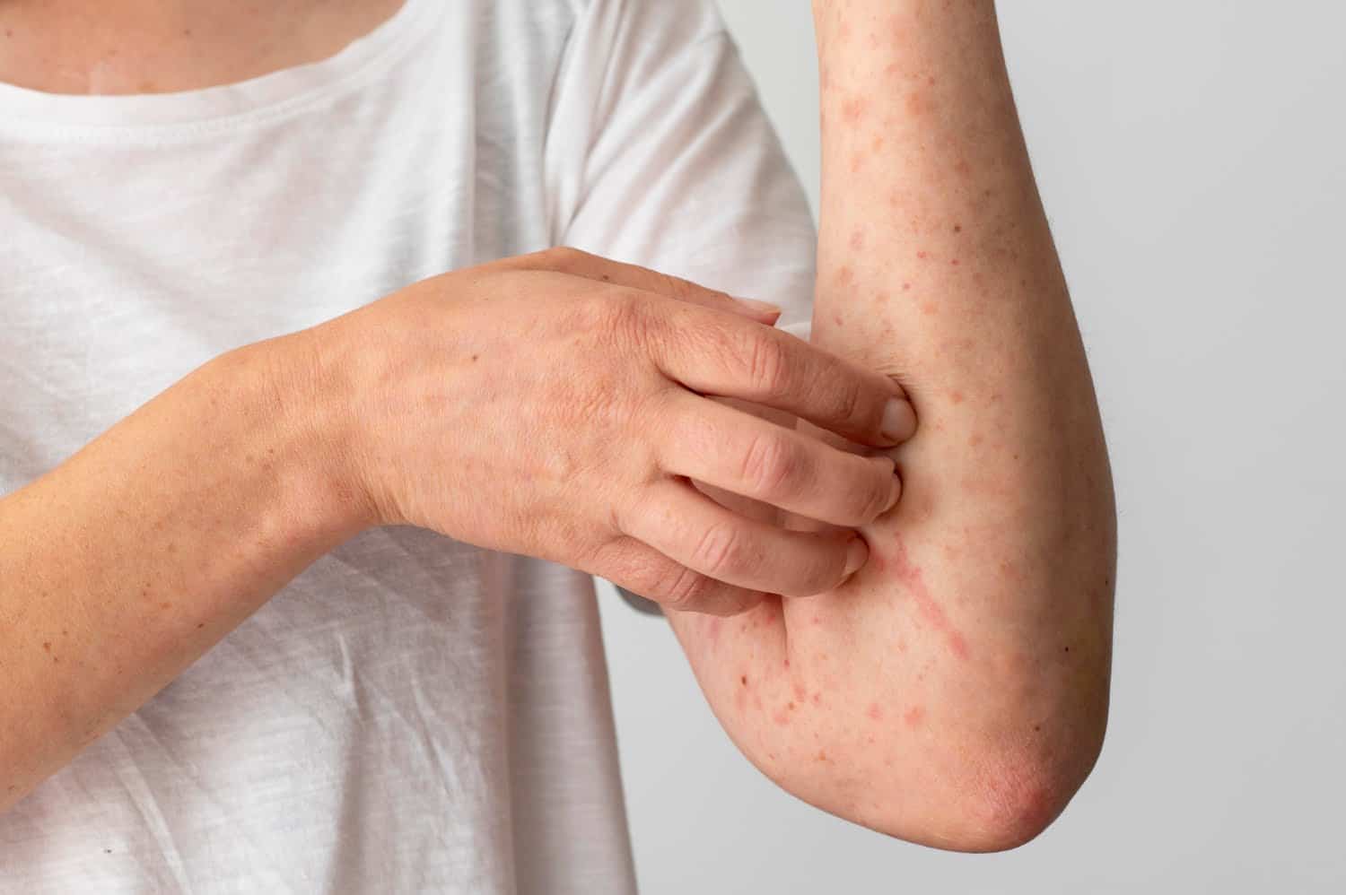 Histaminum : traitement préventif et d’appoint des allergies