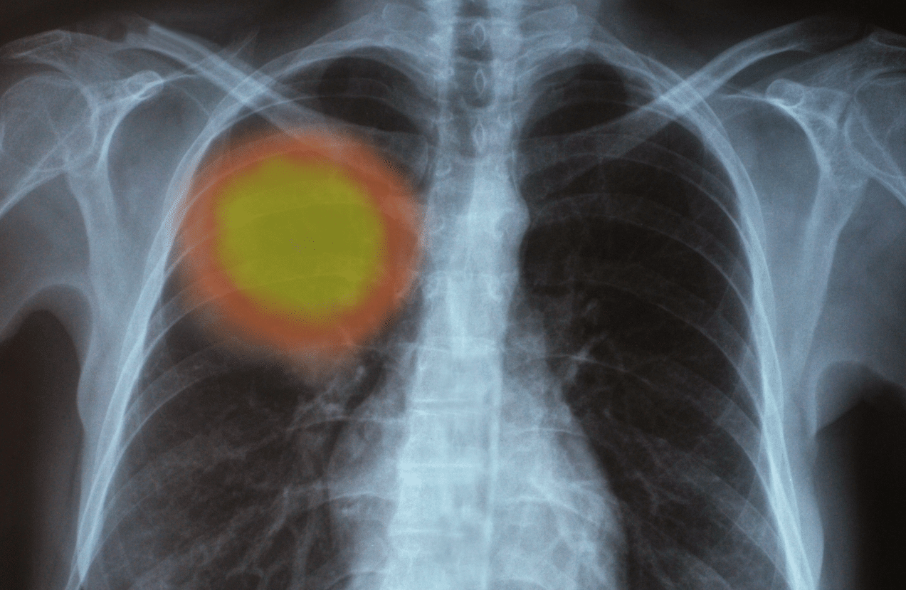 Hausse du risque de cancer du poumon, inflammation de l’intestin: ces préjudices des aliments ultra-transformés sur notre santé