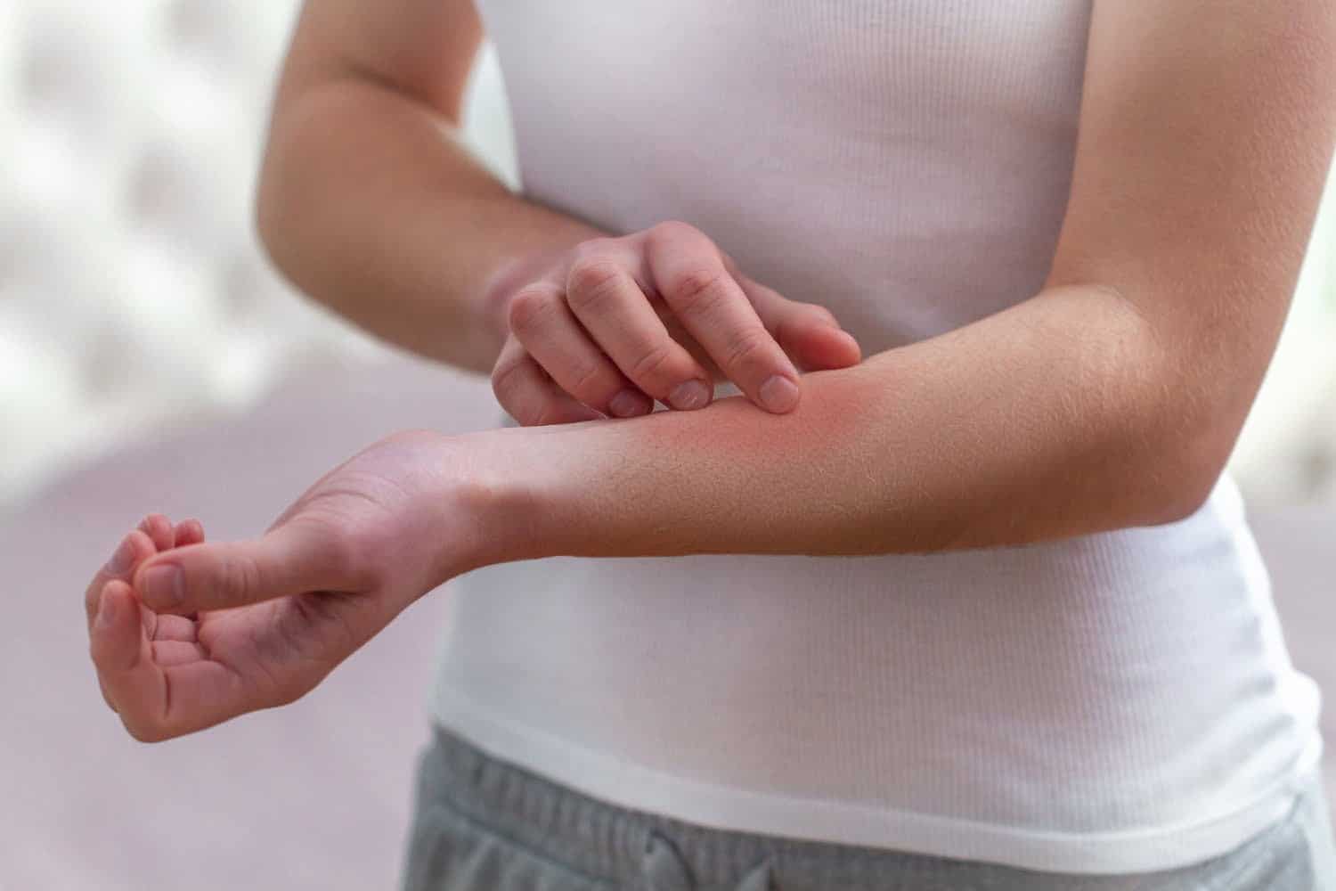 Des solutions naturelles contre l’eczéma