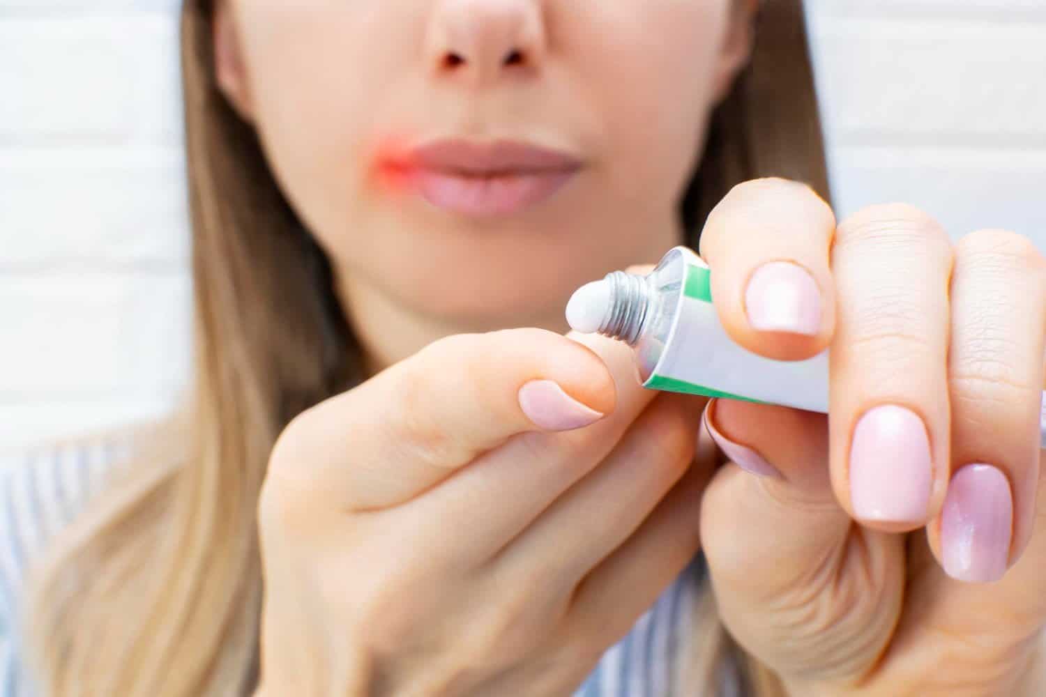 Comment guérir un herpès labial naturellement ?