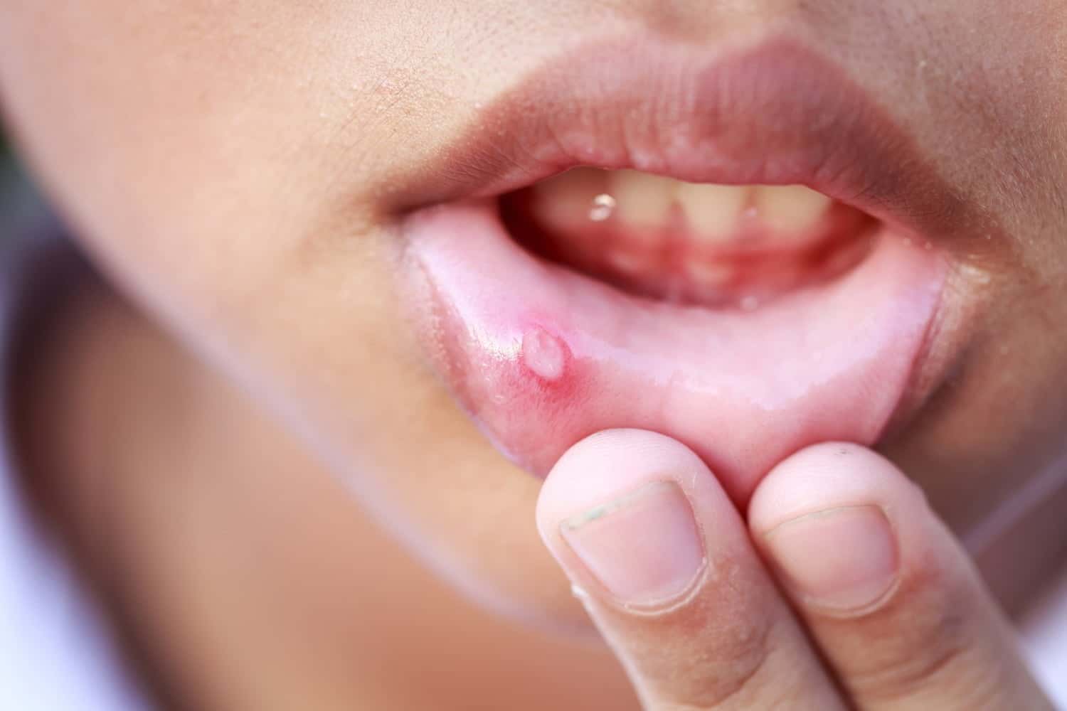 Aphtes buccaux : causes, solutions naturelles et stratégies pour limiter leur apparition