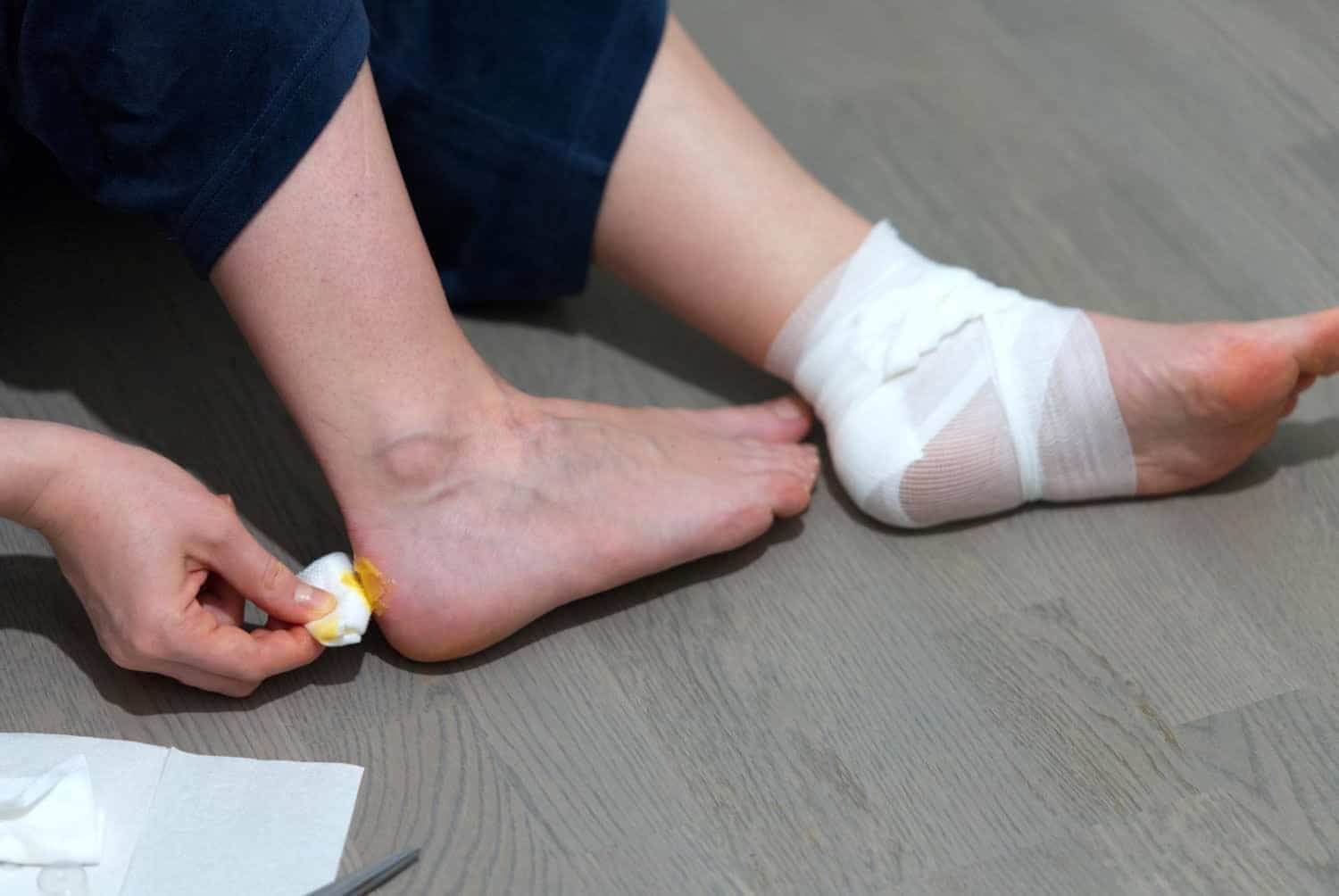 Ampoules : les astuces naturelles pour les chasser et soulager la douleur