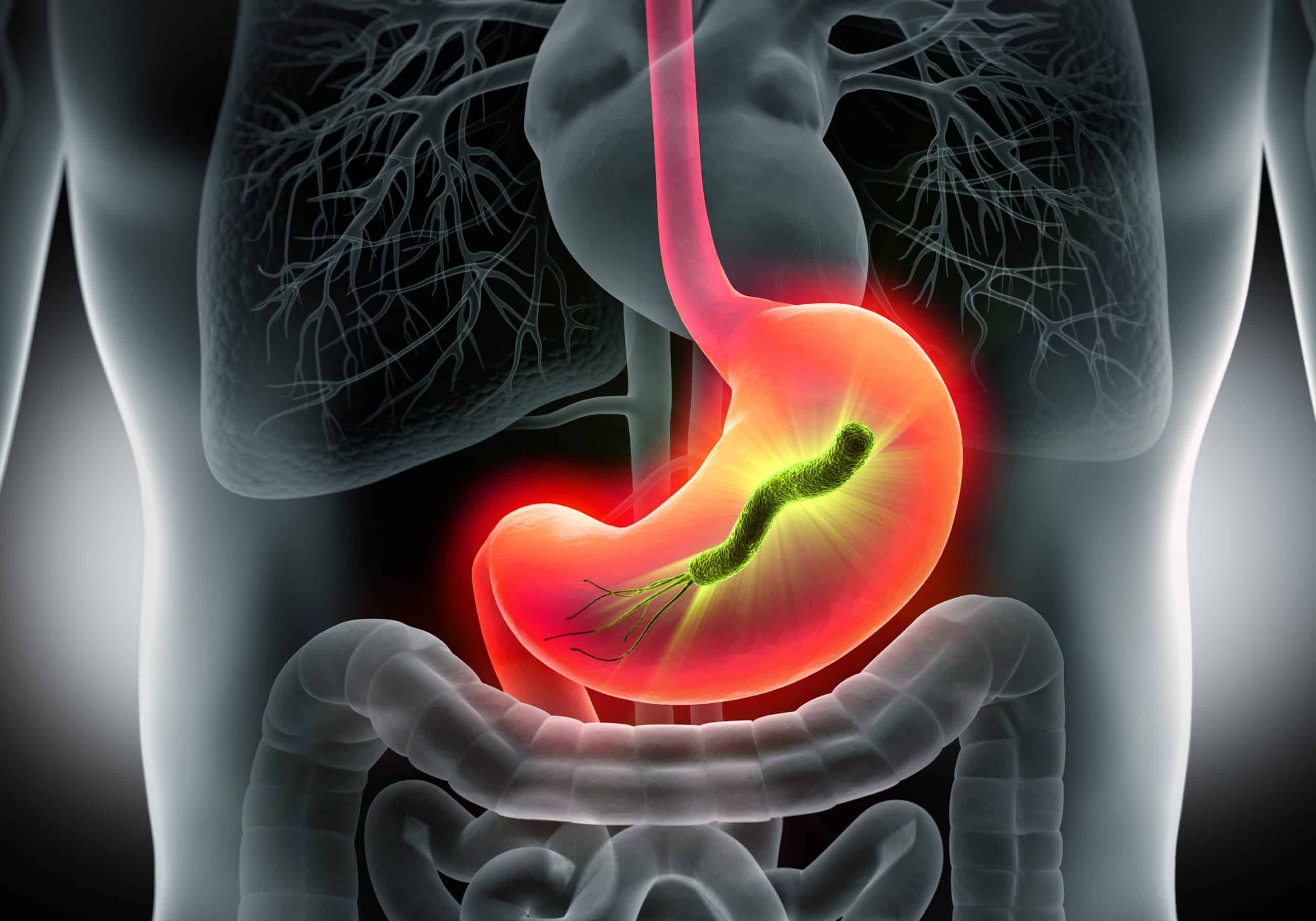 Helicobacter pylori : 5 remèdes naturels pour se soigner
