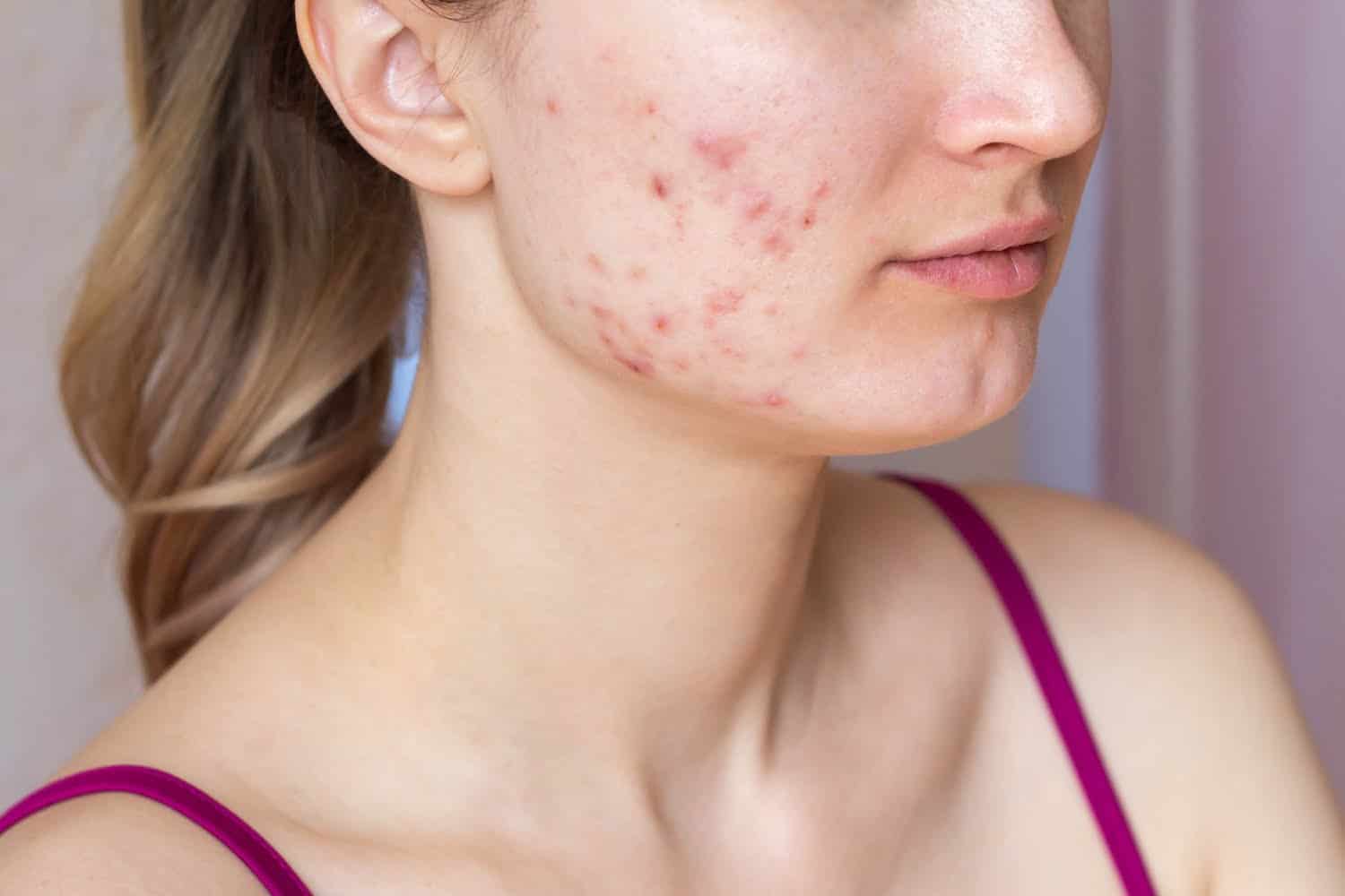 Acné: comment fabriquer et utiliser un masque purifiant au miel et la cannelle