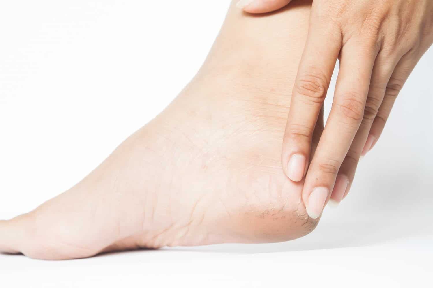Comment soulager les crevasses Naturellement