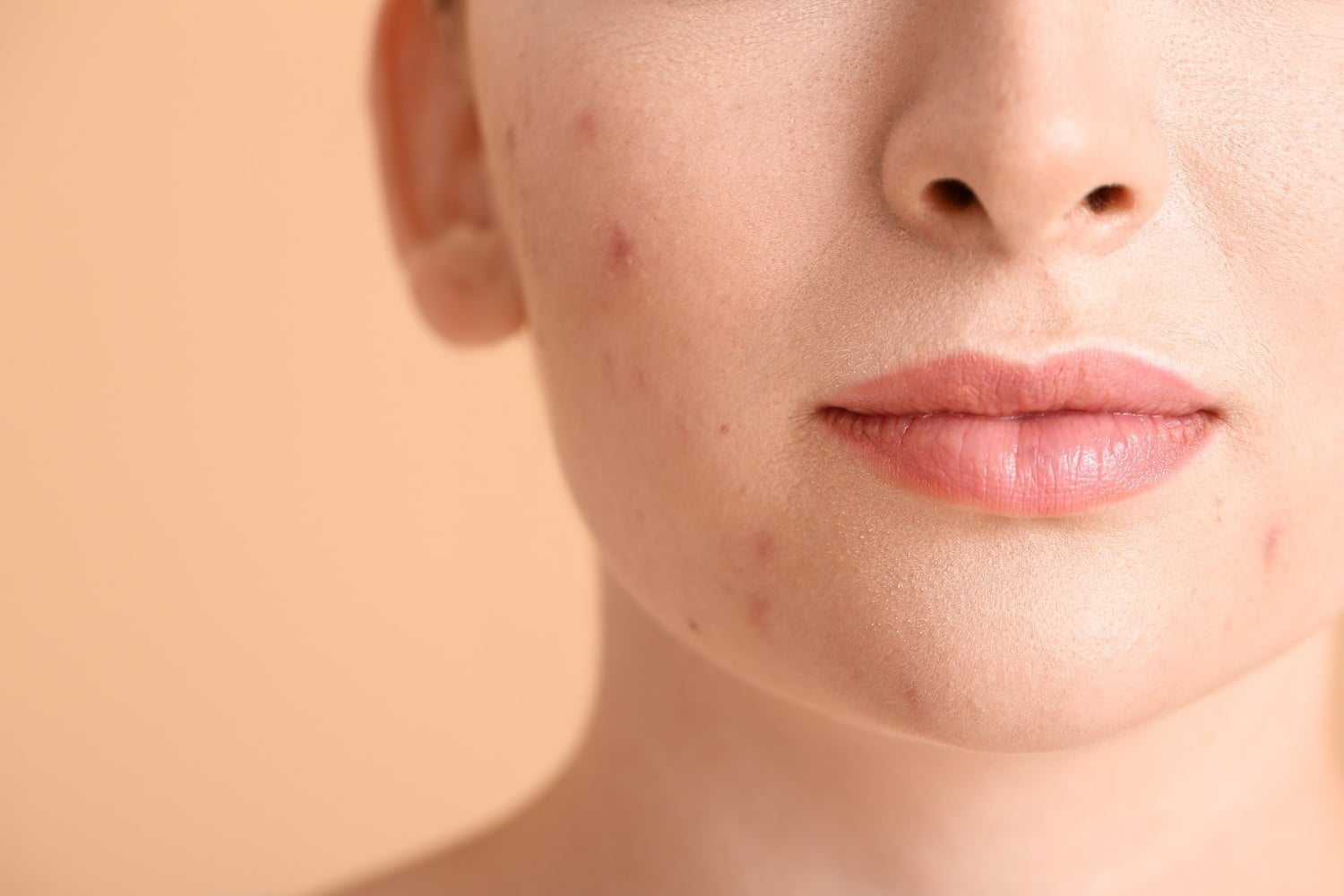 Les routines de soins de la peau pour dire adieu à l’acné