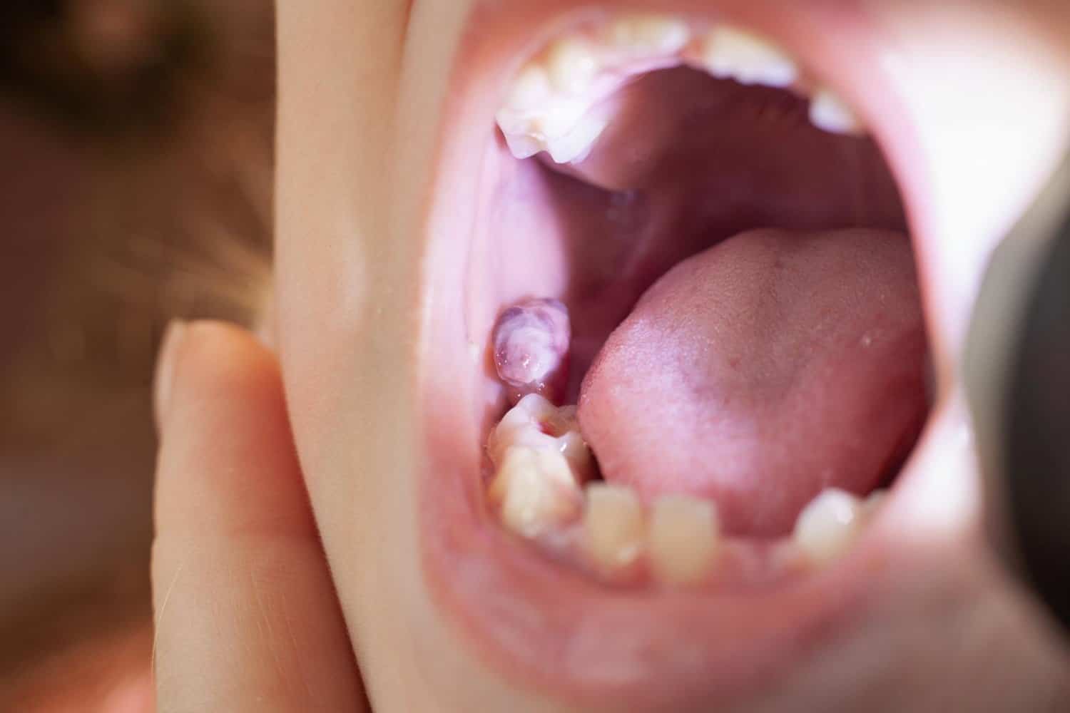Abcés dentaire: ne pas trainer pour le faire soigner par un dentiste