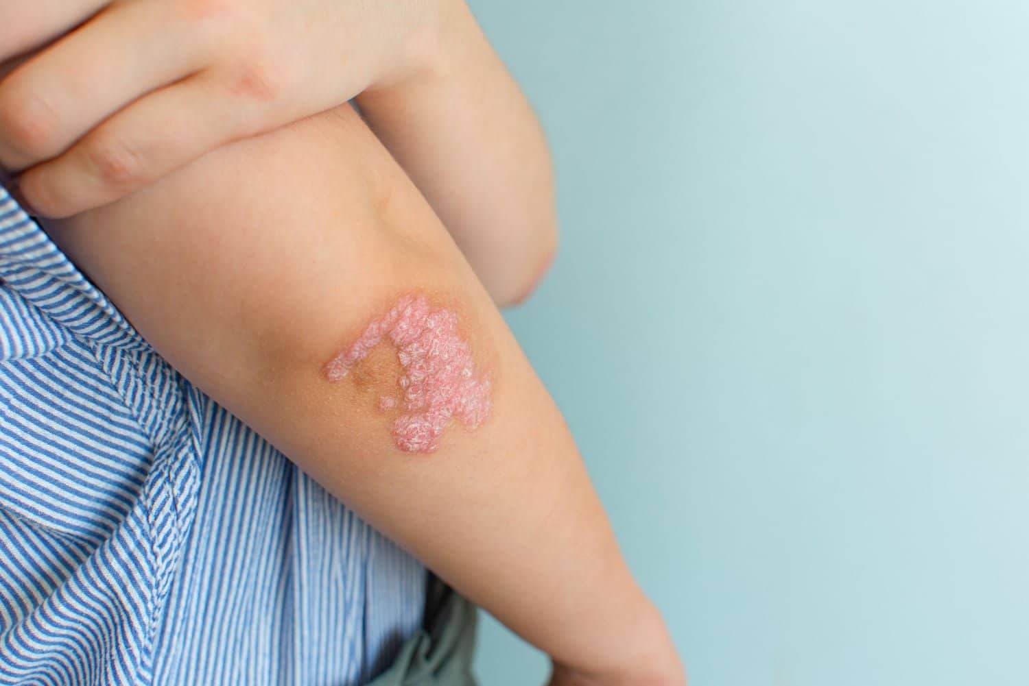 Psoriasis: le gel d’aloe vera pour soulager inflammation, brûlure et démangeaison