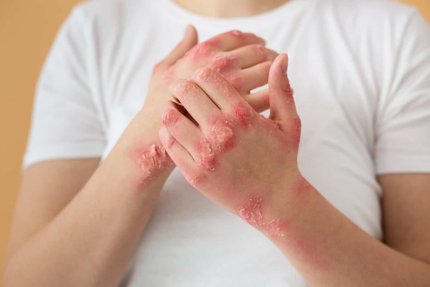 Comment réduire et prévenir l’eczéma naturellement ?