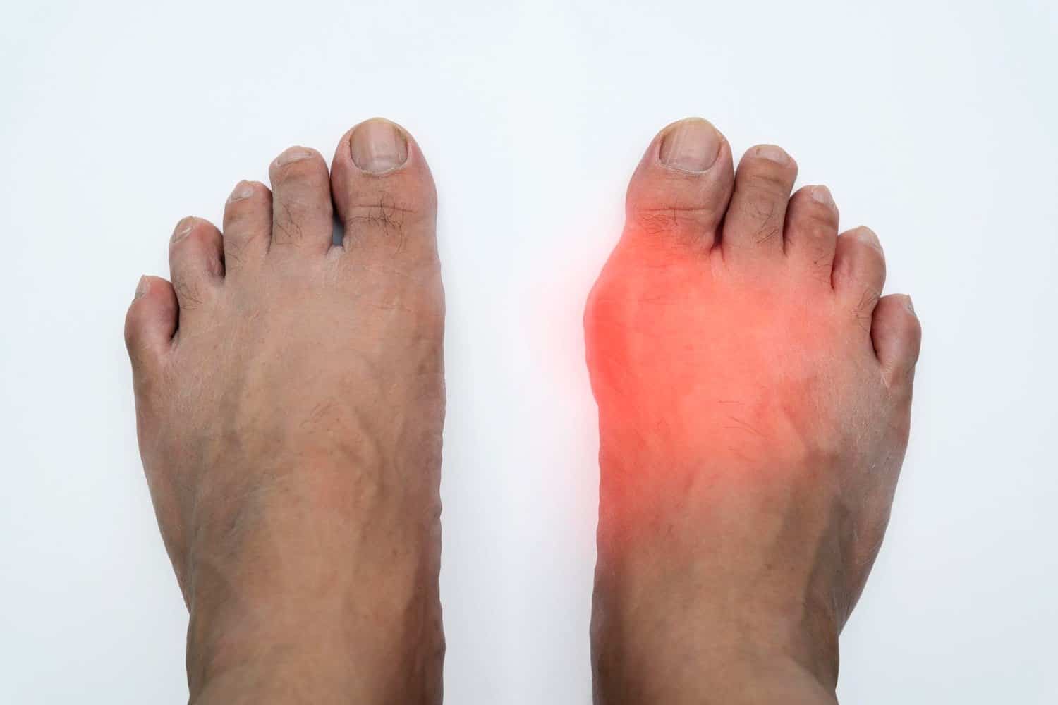 Hyperuricémie : Voici les 7 éléments à considérer !
