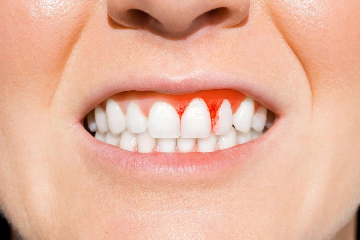 Saignement des gencives: l’astuce de la vitamine C en supplément