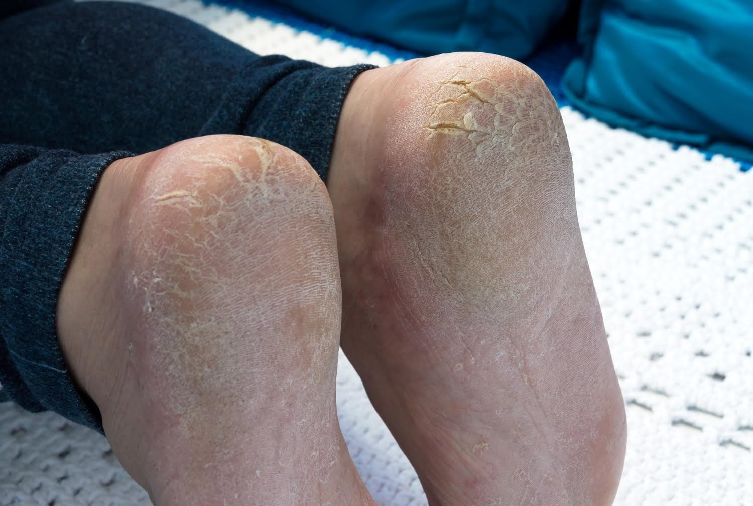 Comment soigner efficacement les talons fendillés 
