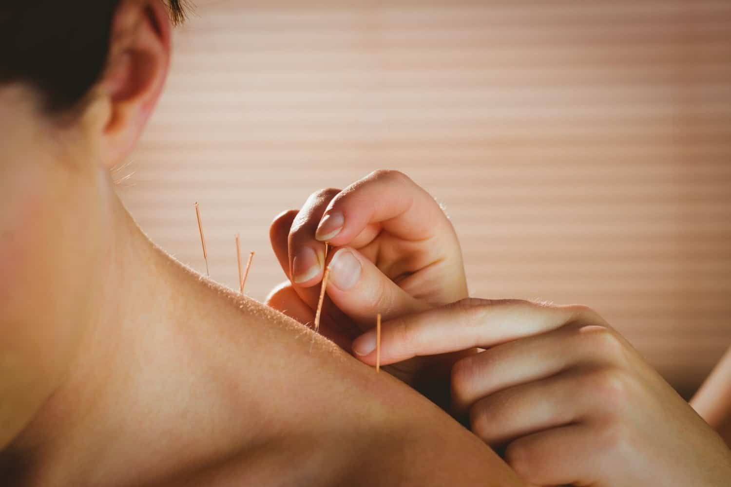 Acupuncture pour la lombalgie chronique : plus efficace que les médicaments selon cette étude