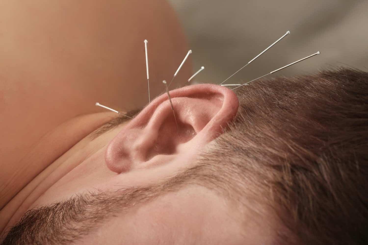 Auriculothérapie : les bénéfices santé des aiguilles sur les oreilles