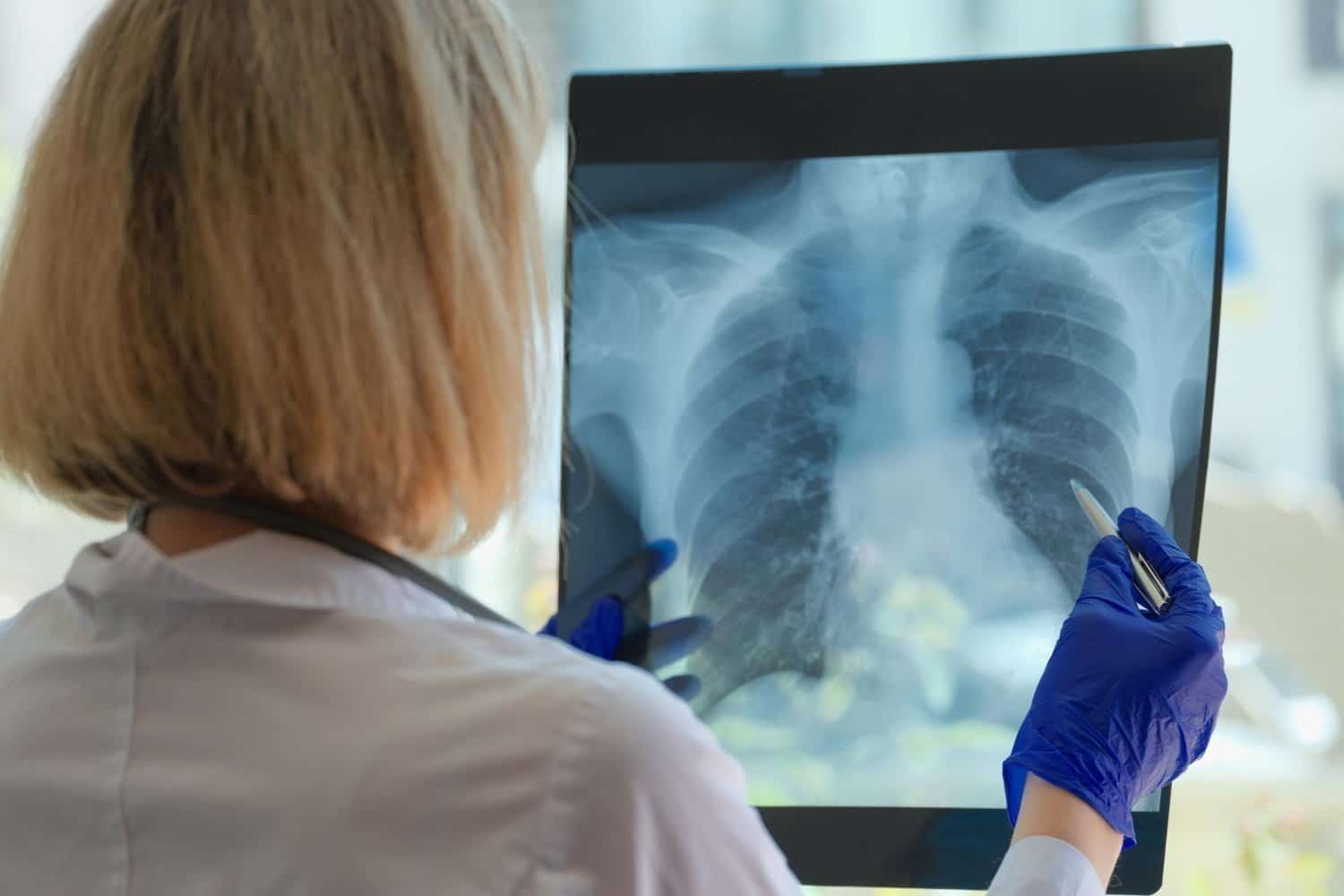 Cancer: fatigue, nausée, survie, l’homéopathie améliore nettement qualité et espérance de vie
