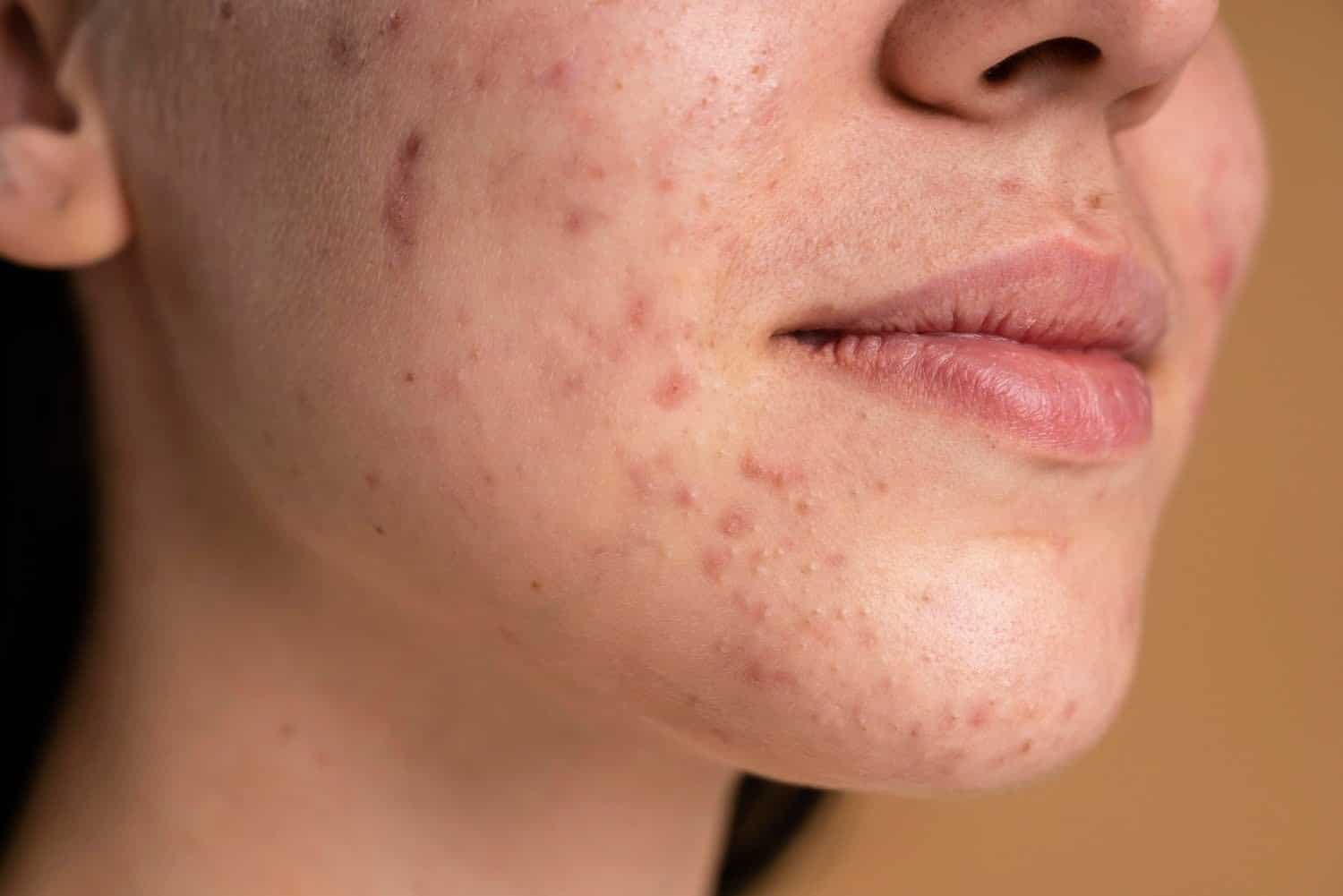 4 vitamines pour combattre l’acné naturellement