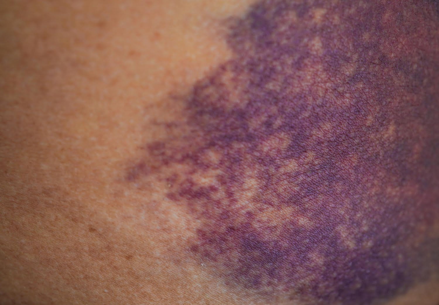 Ecchymoses fréquentes: pourquoi faites-vous des bleus facilement?