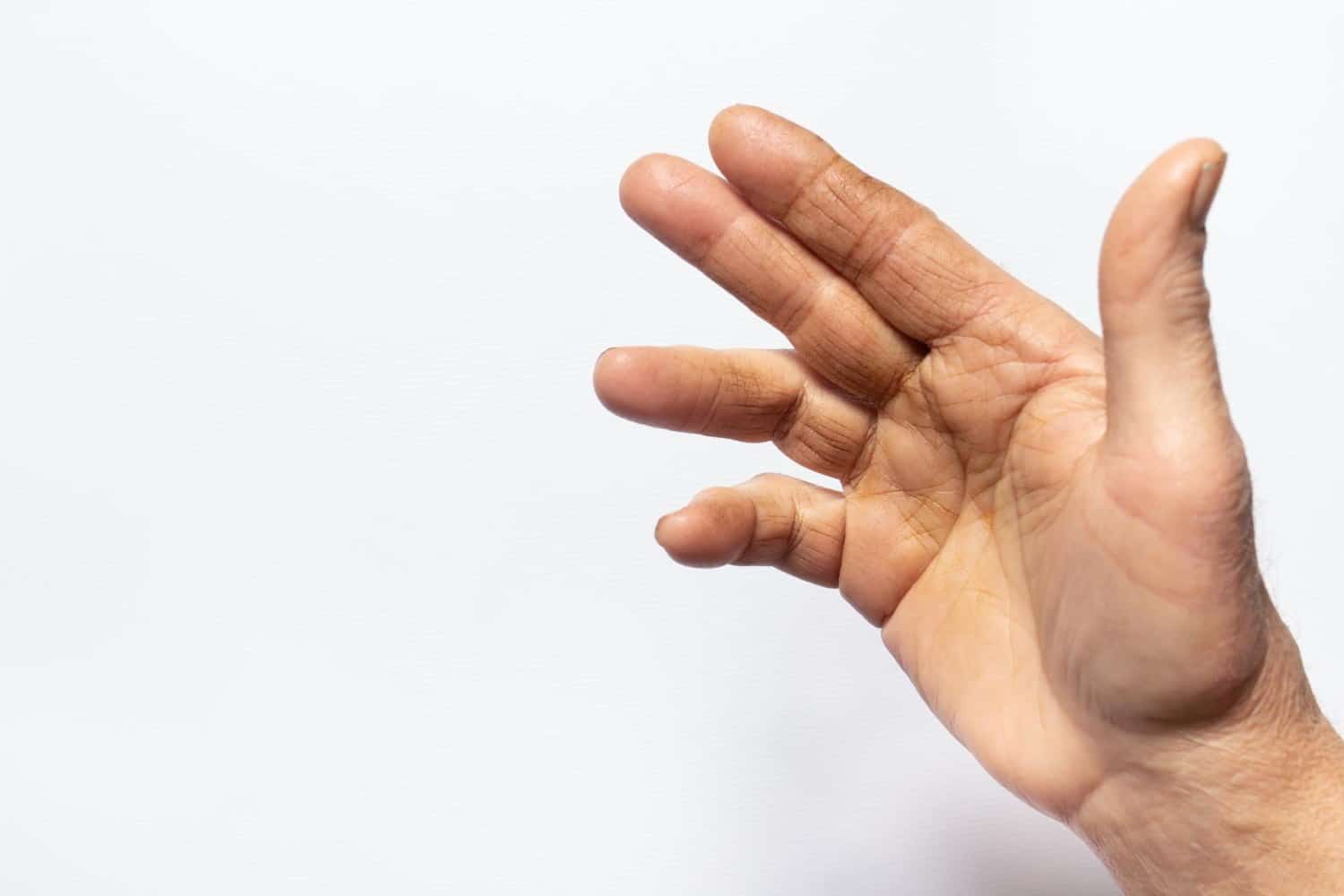 Maladie de Dupuytren: que faire quand les doigts ne veulent plus s’ouvrir