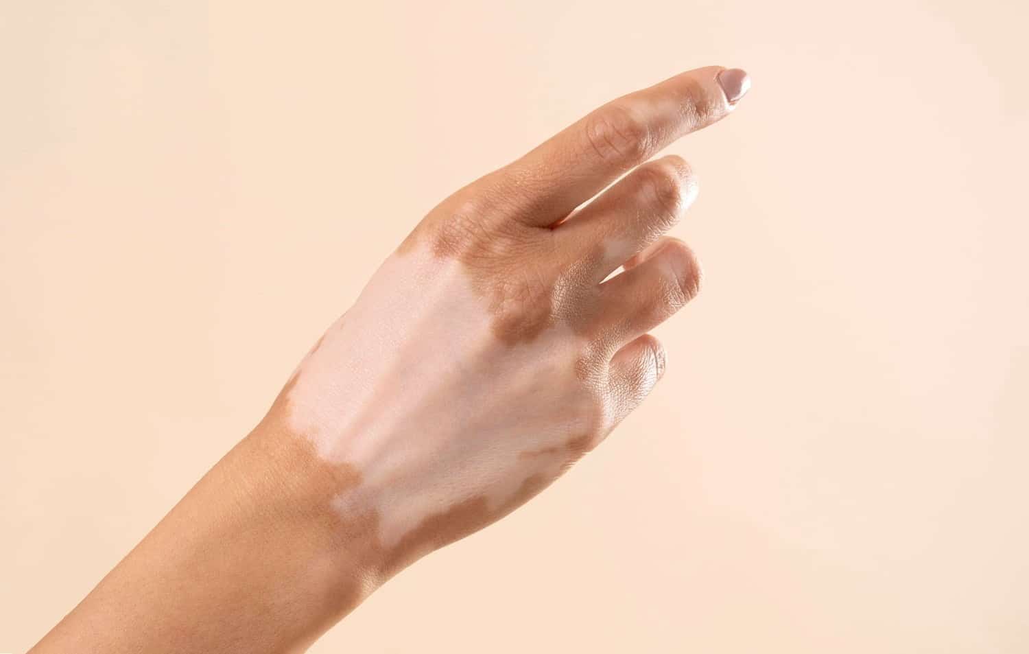Une alimentation pro-inflammatoire associée à la progression du vitiligo