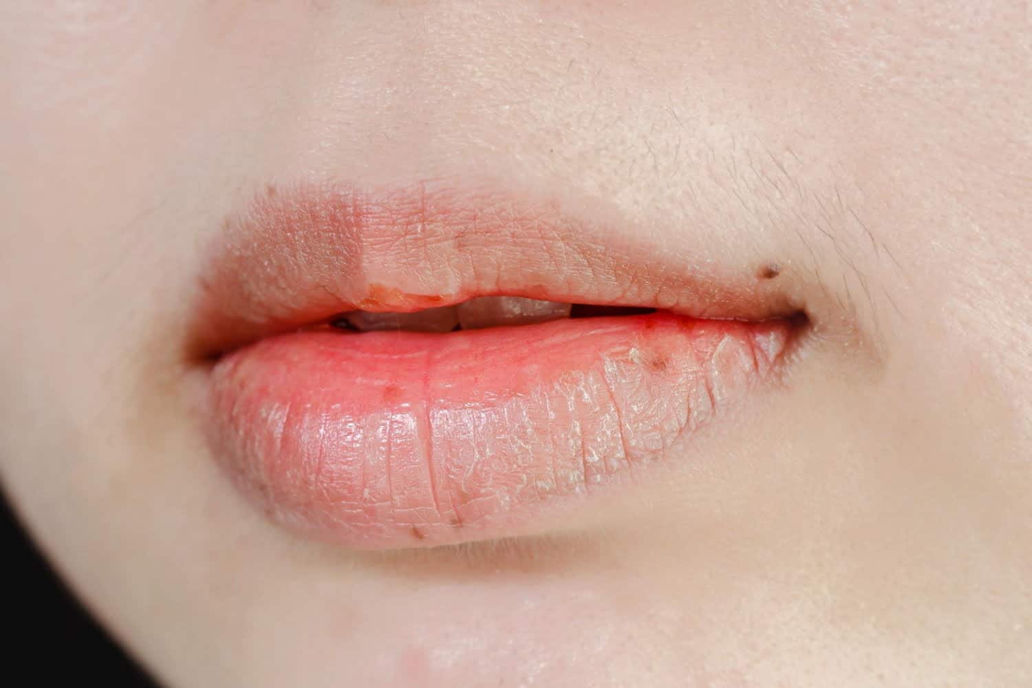6 causes sous-jacentes de la bouche sèche à connaître absolument