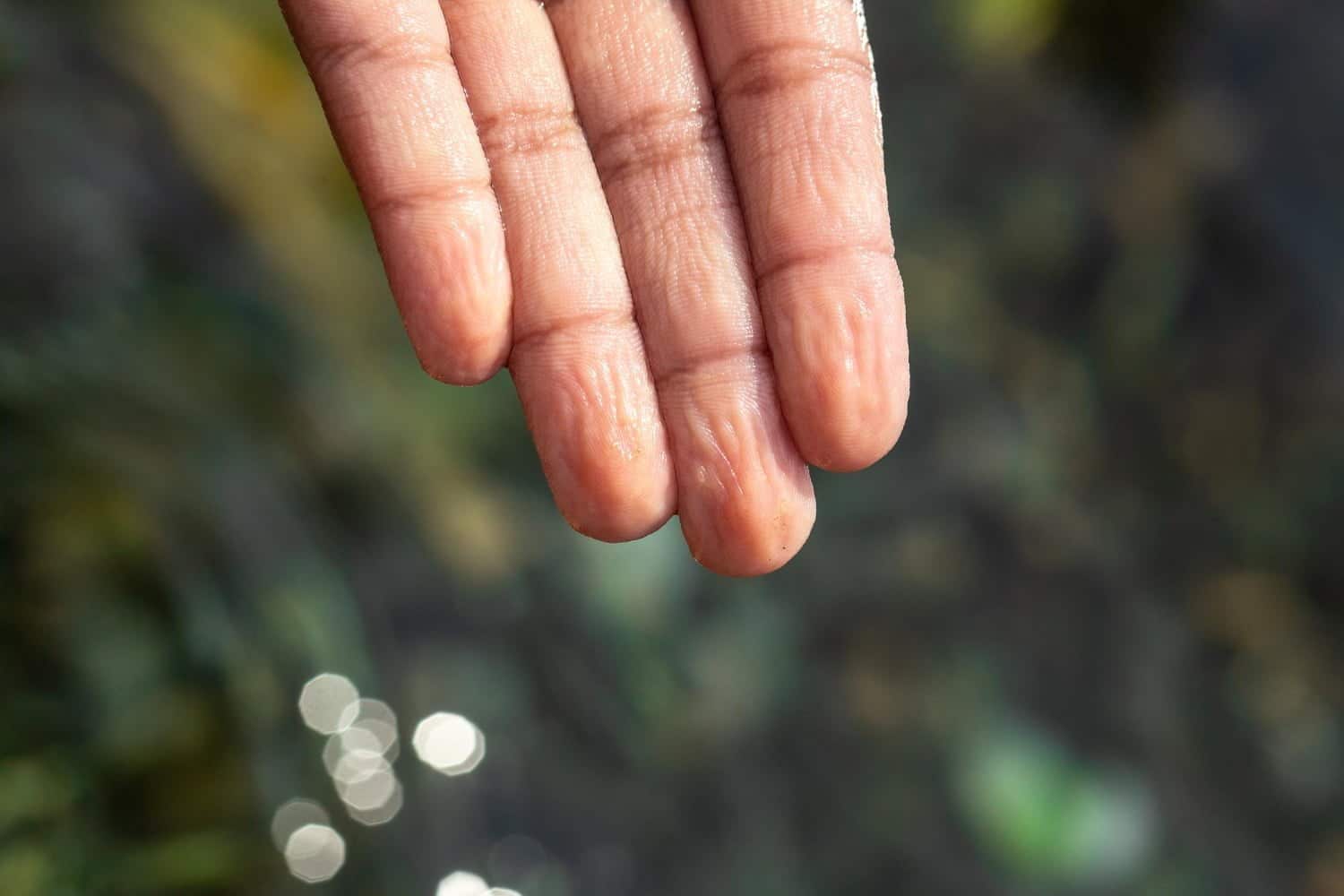 Comment atténuer les symptômes du Syndrome de Raynaud ?