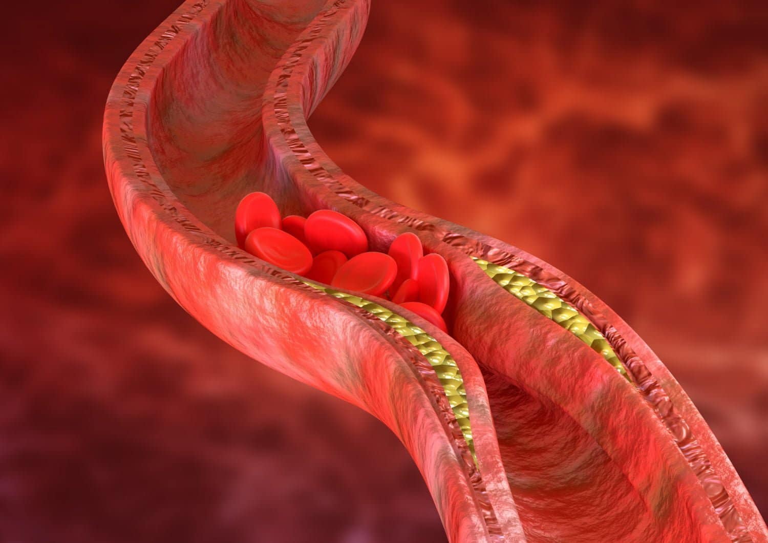 AVC, athérosclérose, crise cardiaque: le rôle mal connu du cholestérol oxydé