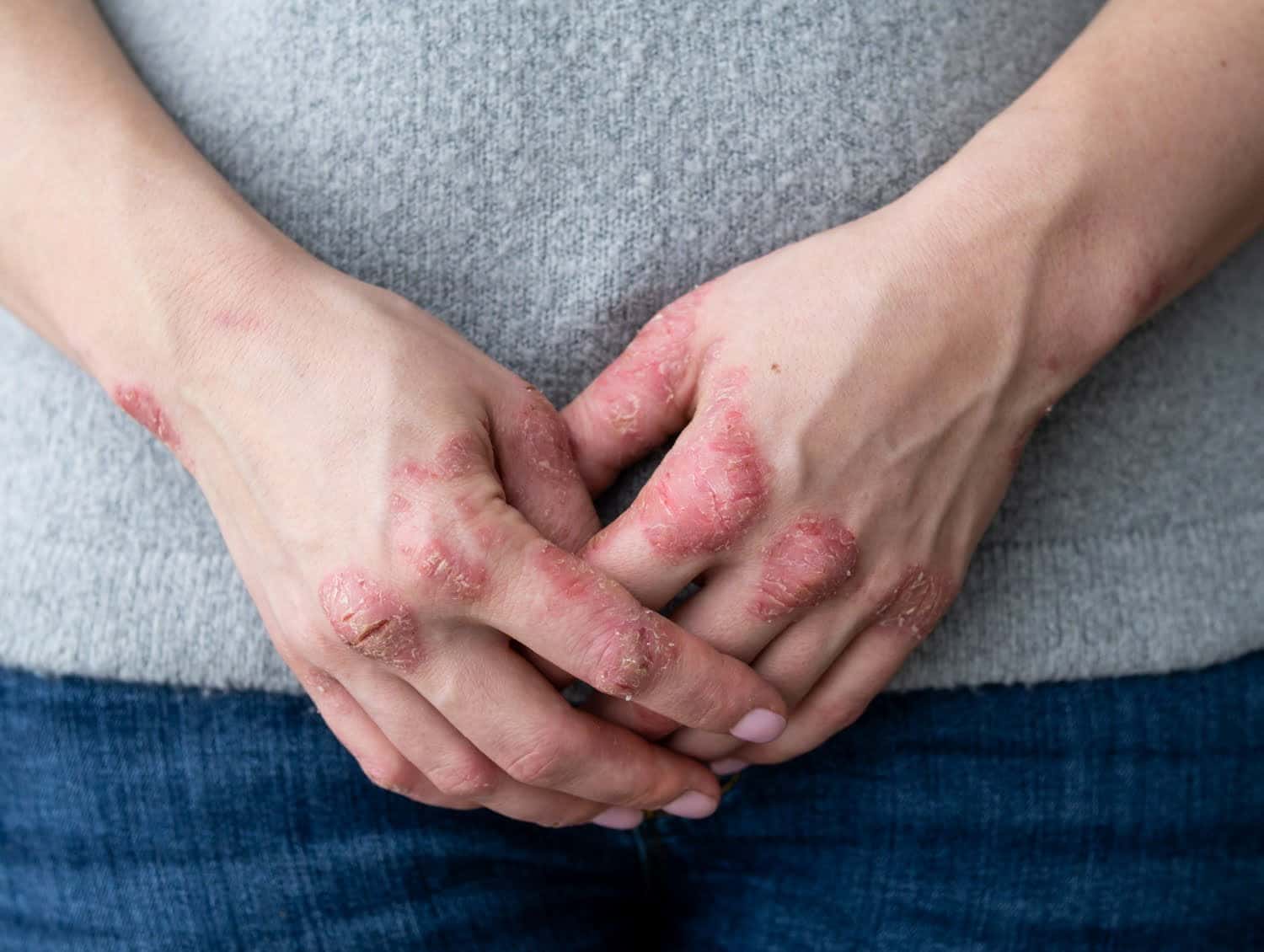 L’eczéma atopique entraine un risque accru de détresse mentale et d’idées noires