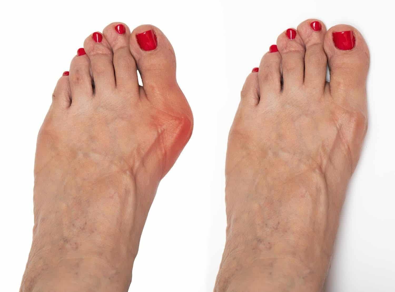 Hallux valgus : 95% des femmes touchées