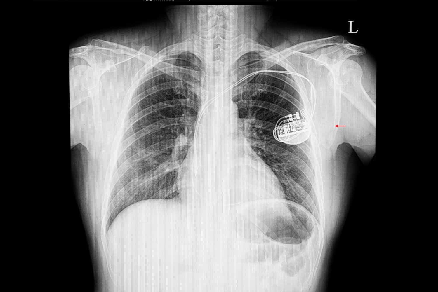 Infections pulmonaires : pourquoi la guérison ne suffit pas à effacer les séquelles ?