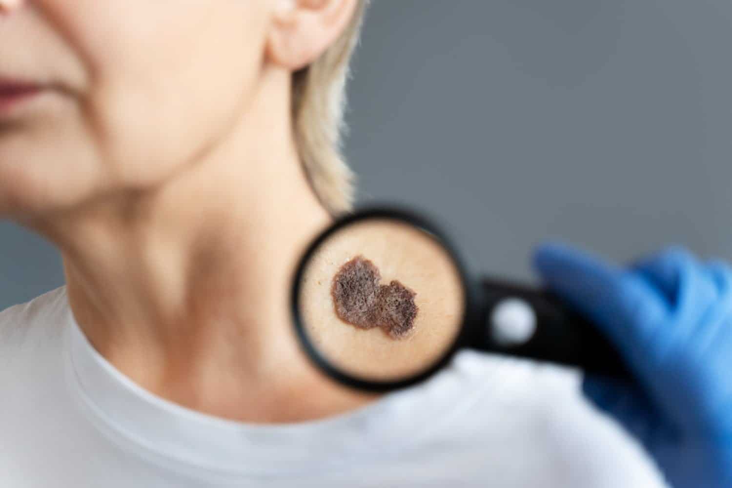 5 signes d’un cancer de la peau autre qu’un grain de beauté suspect