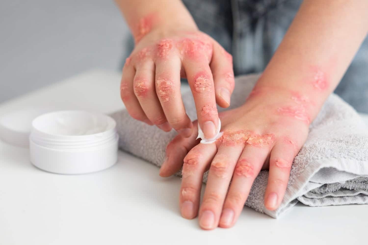Les 4 huiles essentielles qui soulagent les symptômes de l’eczéma