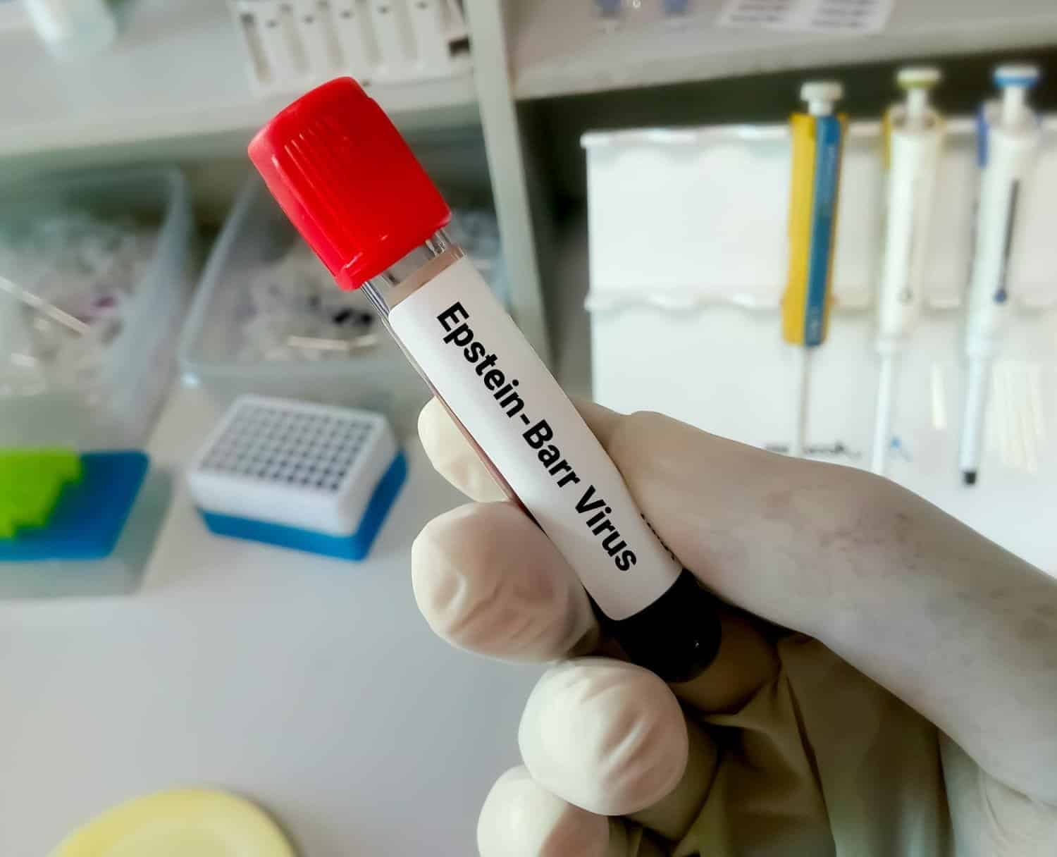 Lupus et virus Epstein-Barr : une étude relie la maladie à un virus qui infecte 95 % des adultes