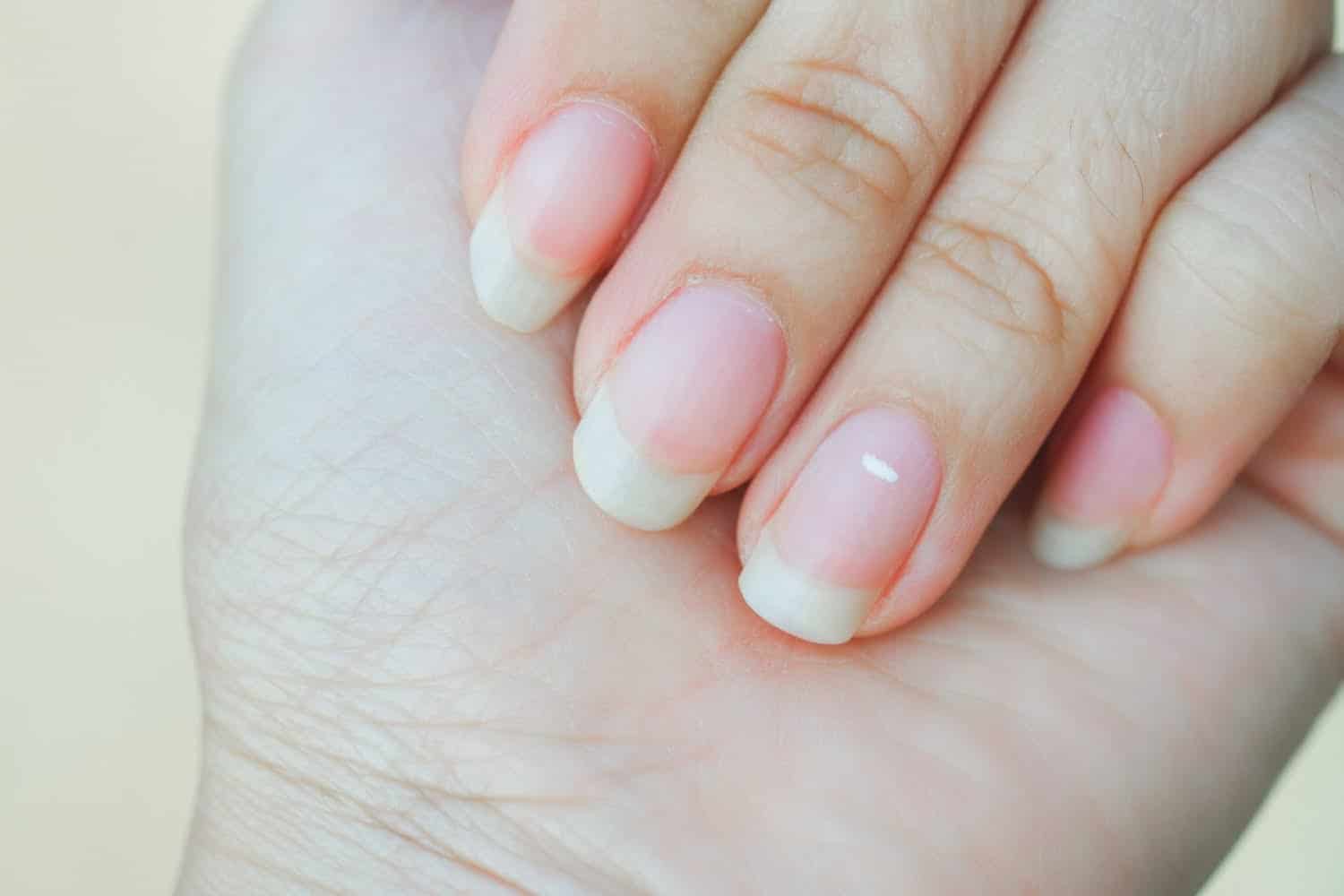 Taches ou bandes blanches sur les ongles: d’où elles viennent, comment les traiter?
