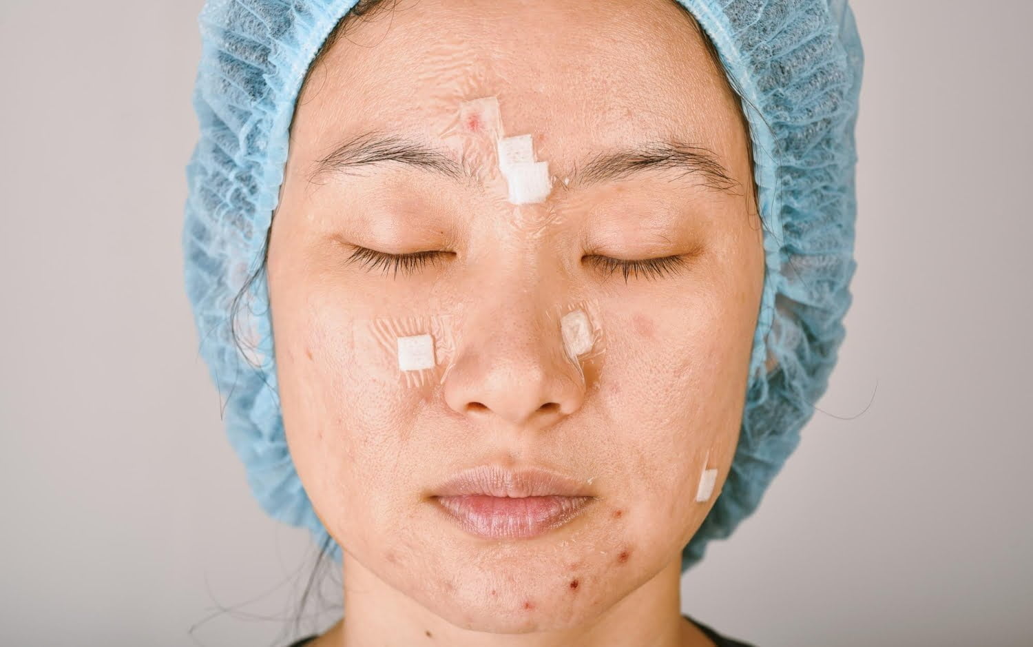 Acné, rides, rougeurs sur le visage: ce qu’ils disent de votre santé générale