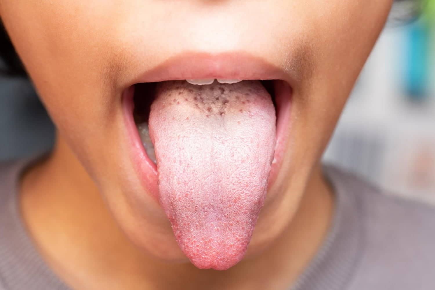 9 symptômes de la candidose que vous ignorez et les solutions naturelles