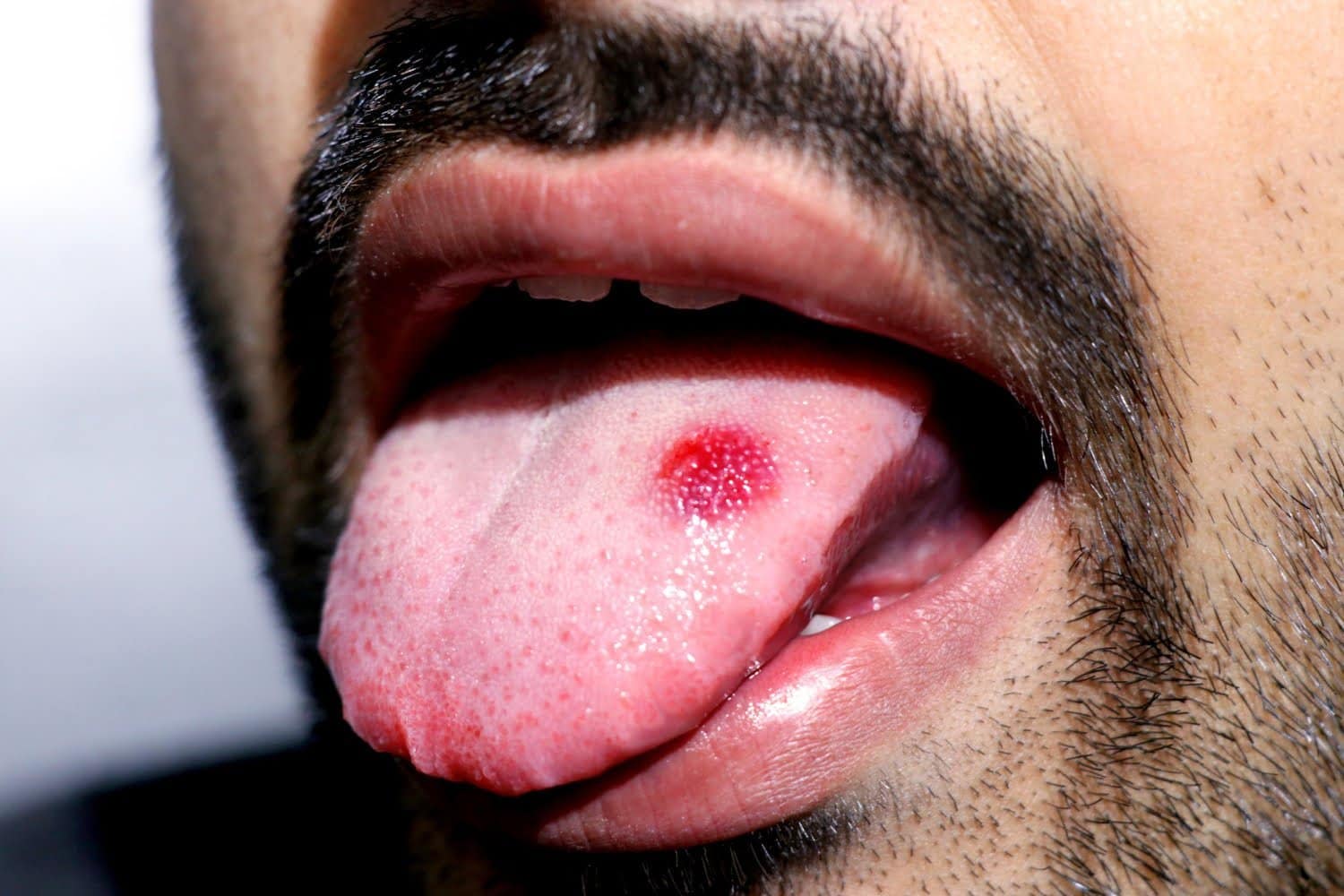 Cancer de la bouche: ces facteurs qui augmentent le risque
