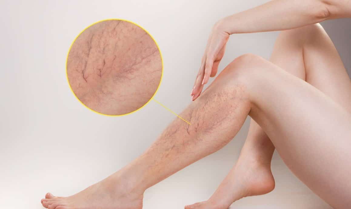 Varices: causes, symptômes et traitement