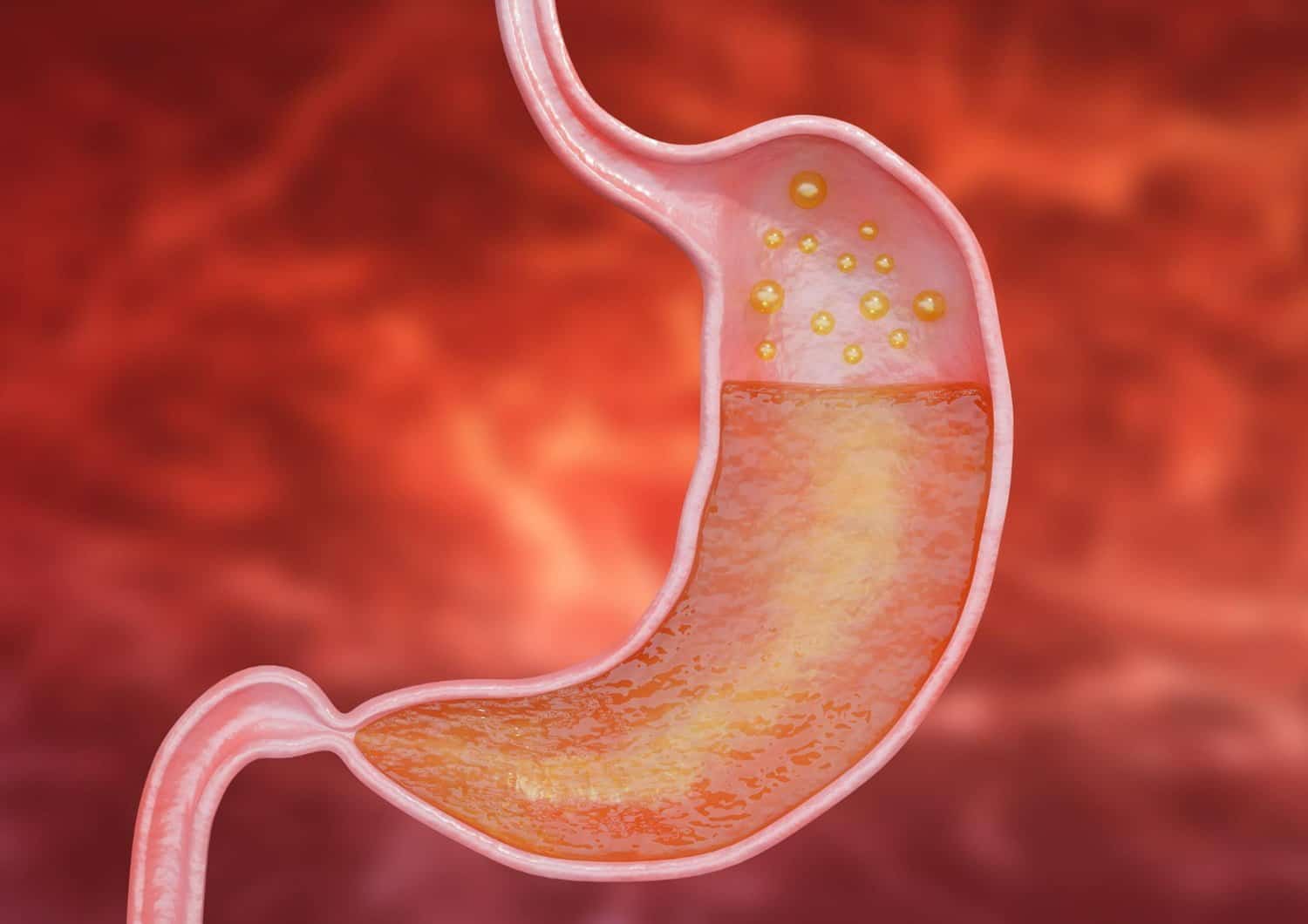 Cancer gastrique avancé : quels aliments manger et éviter ?