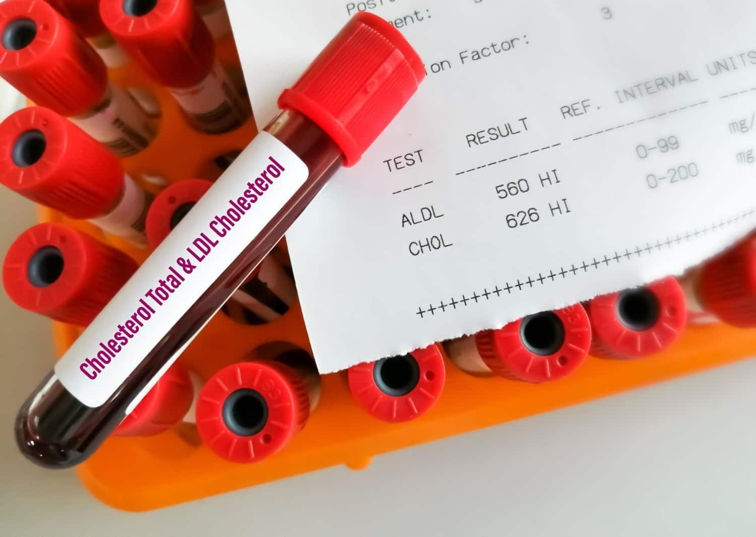 Augmentation soudaine du cholestérol: les 6 raisons principales et ce qu’il faut faire