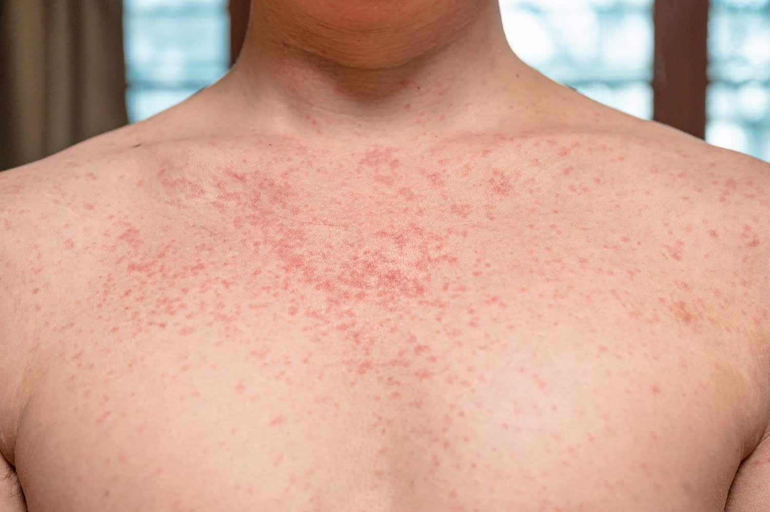 Poussées de psoriasis sévères : attention à l’alcool