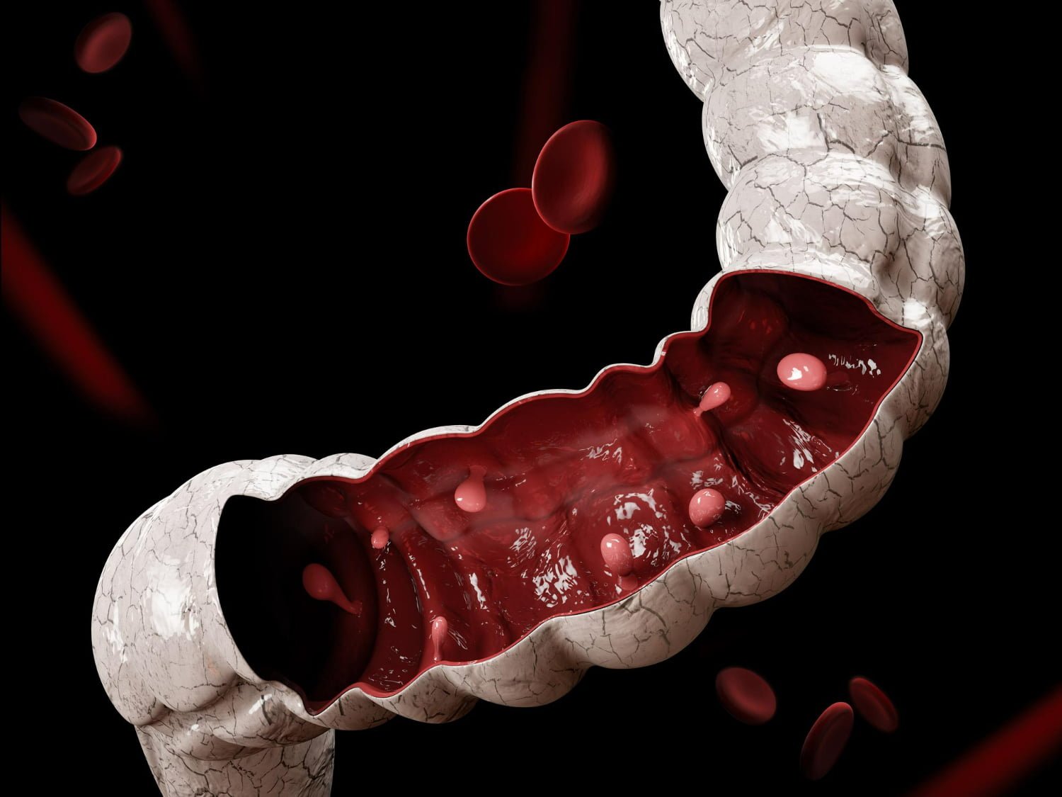 Cancer colorectal : coloscopie et test FIT à 60 ans détectent plus tôt les cancres et permettent de sauver des vies