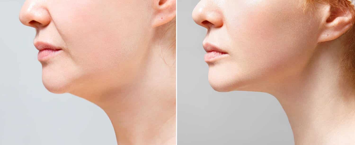 Comment réduire la graisse du visage