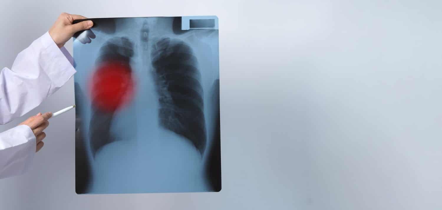 Les symptômes précoces du cancer du poumon et les maladies y ressemblent
