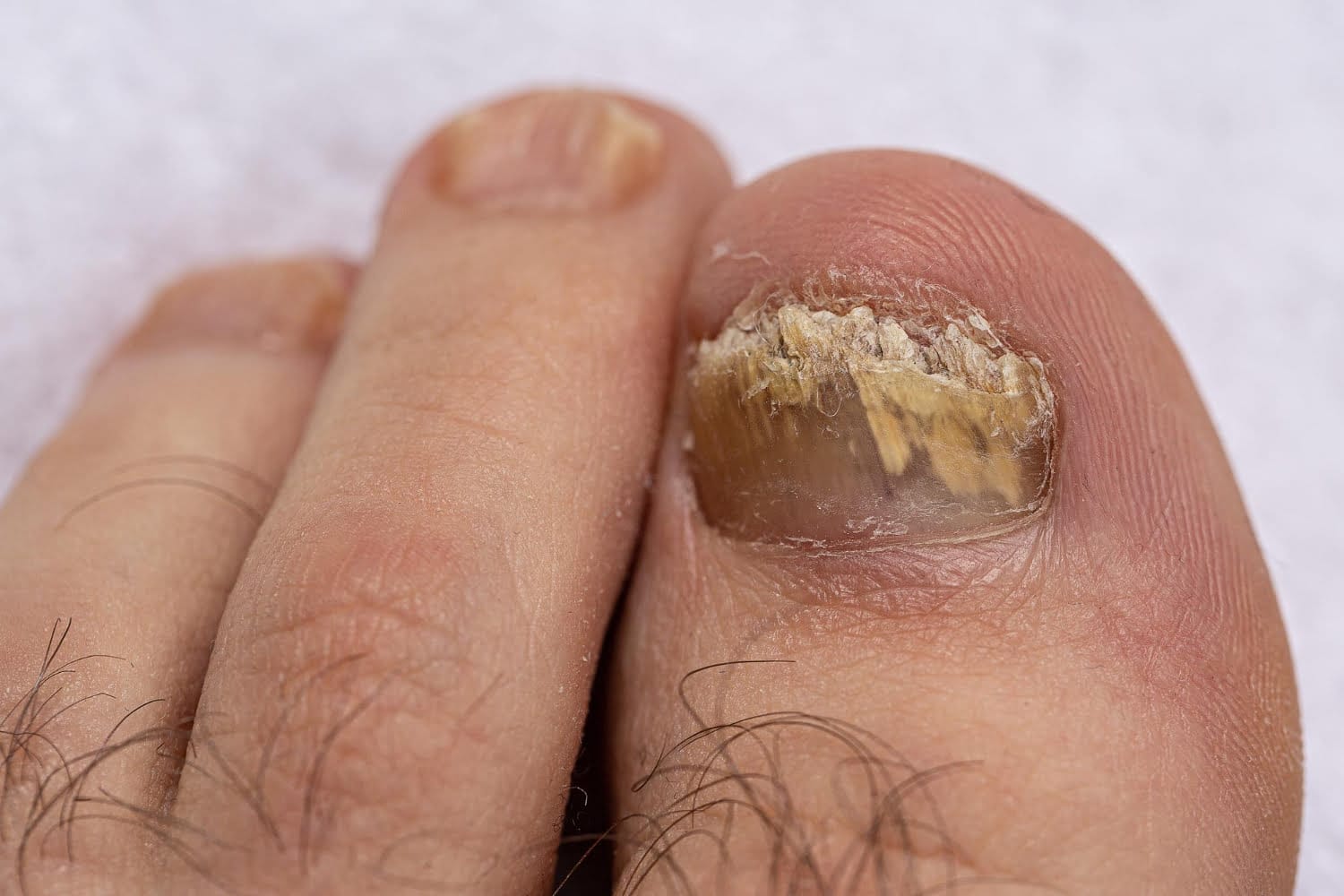 Détecter des maladies : indices cachés sur les ongles